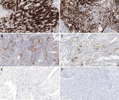 Expression of CD274 mRNA Measured by qRT-PCR Correlates With PD-L1 Immunohistochemistry in Gastric and Urothelial Carcinoma